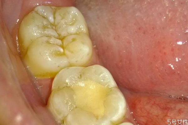 牙龈红肿的危害有什么呢(牙龈长期红肿的危害)