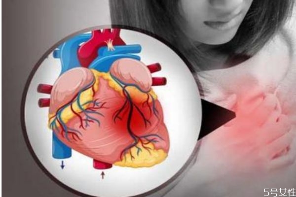 急性心肌梗死的征兆是什么呢(关于心肌梗死的前期征兆有哪些) 急性心肌梗死的征兆是什么呢(关于心肌梗死的前期征兆有哪些)