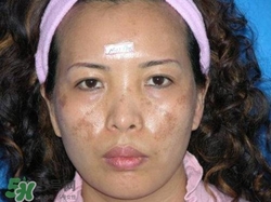 喝藏红花能去黄褐斑吗,藏红花对黄褐斑有效果吗