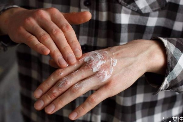 湿疹应该怎么治疗呢(湿疹应该怎么治疗呢)