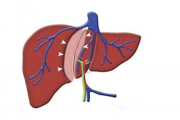 甲肝应该怎么治疗呢(甲肝需要怎么治疗)