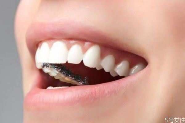 带牙套要注意什么呢(戴牙套需要注意些什么)