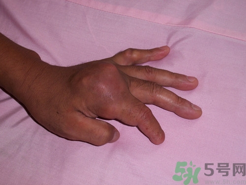 痛风能吃牛板筋吗,痛风能不能吃牛筋