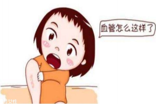 容易患静脉曲张的主要人群有哪些(静脉曲张容易引起什么病) 容易患静脉曲张的主要人群有哪些(静脉曲张容易引起什么病)