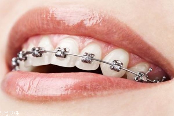 牙套有什么作用呢(牙套起什么作用)
