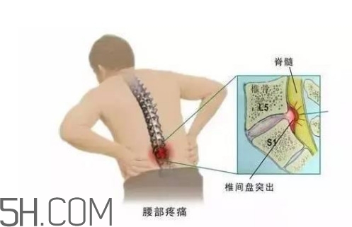 腰椎间盘突出什么原因导致的,腰间盘突出是什么原因引起的怎么办