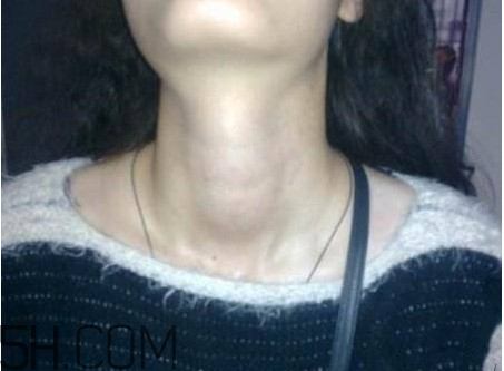 甲状腺结节挂什么科室的号,甲状腺结节该挂什么科