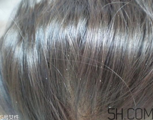 头皮屑和虱子的区别,头虱和头皮屑怎么区分图片