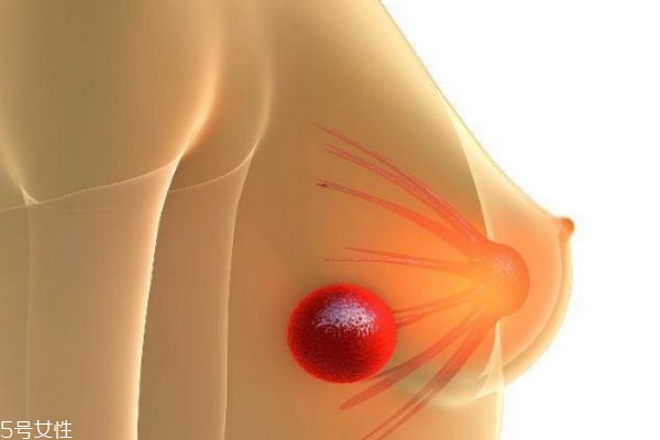 乳腺结节严重吗(乳腺结节严重吗,要怎么治疗呢)