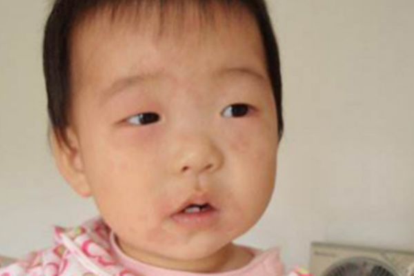 幼儿急疹痒吗(幼儿急疹痒吗 为什么宝宝特别烦躁) 幼儿急疹痒吗(幼儿急疹痒吗 为什么宝宝特别烦躁)