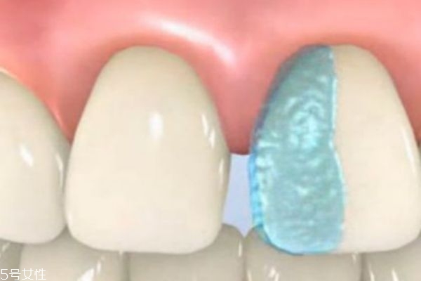 牙缝大用牙缝刷效果好(牙缝刷好用吗)