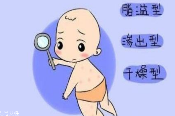 湿疹的类型(湿疹的类型及表现)