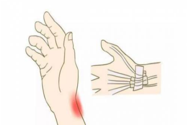 如何预防腱鞘炎(预防腱鞘炎有哪些好的方法?)