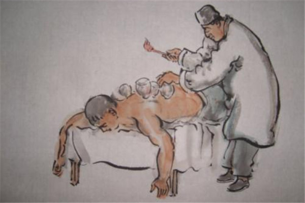 孕妇可以拔火罐吗后背,孕妇可以拔罐吗