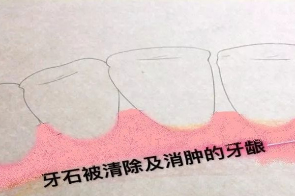 洗牙的方法步骤和注意事项,洗牙的方法步骤 洗牙的方法步骤和注意事项,洗牙的方法步骤