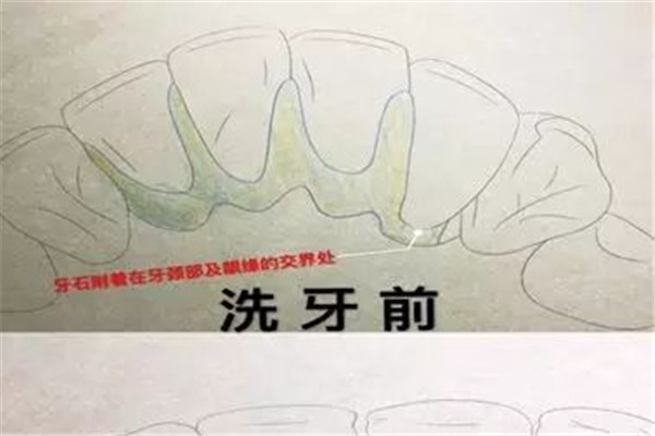 如何预防烂嘴角(如何预防烂嘴角)
