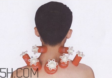 脖子拔罐有什么好处,拔罐拔脖子有什么用处