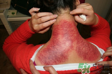 刮痧治疗颈椎病的方法,颈椎不好可以刮痧吗