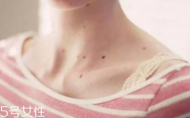 什么样的色素痣需要及时处理(色素痣要不要除掉)