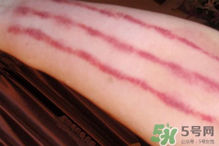 揪痧和刮痧有什么区别,揪痧和刮痧的作用有什么区别