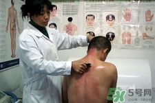 背部刮痧可以祛痘吗,脸上长痘背部刮痧可以祛痘吗
