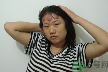 可以在额头上拔火罐吗头痛的时候,头痛可以在头部拔火罐吗