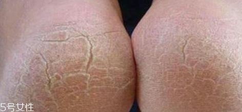 如何预防手脚干裂(怎样预防手脚干裂)