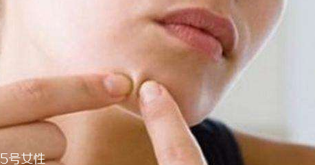 长痘的原因(长痘的原因是什么引起的)