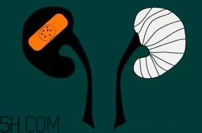 慢性肾炎会变尿毒症吗(慢性肾炎会变尿毒症吗?)