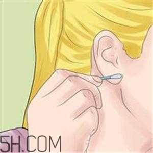 打耳洞怎么不引发瘢痕疙瘩(瘢痕疙瘩为什么不能打耳洞) 打耳洞怎么不引发瘢痕疙瘩(瘢痕疙瘩为什么不能打耳洞)