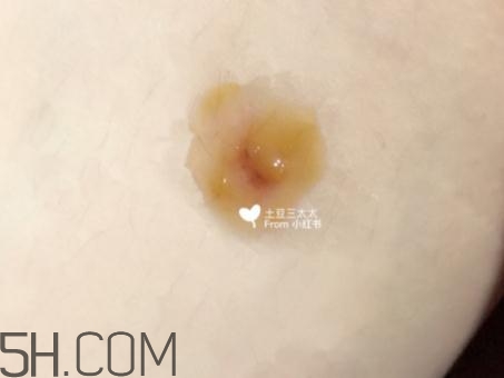 美宝湿润烧伤膏用法(美宝湿润烧伤膏用法用量)