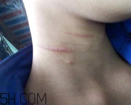 密丽除疤膏效果好吗(密丽除疤膏效果好吗疤痕增生) 密丽除疤膏效果好吗(密丽除疤膏效果好吗疤痕增生)