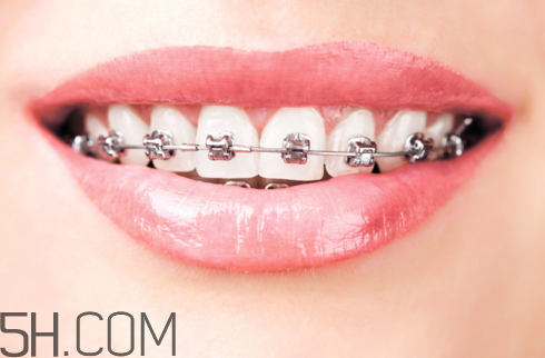 戴牙套怀孕对身体有什么影响(戴牙套对怀孕有影响吗) 戴牙套怀孕对身体有什么影响(戴牙套对怀孕有影响吗)