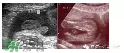 如果通过b超单看男女,看b超单子看男女准吗