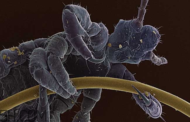 虱子咬有什么症状(被虱子咬的症状)