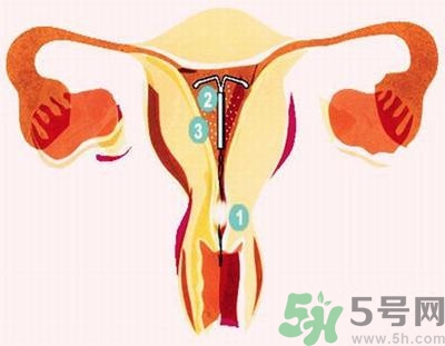上环的坏处有哪些,避孕环的副作用有哪些 上环的坏处有哪些,避孕环的副作用有哪些