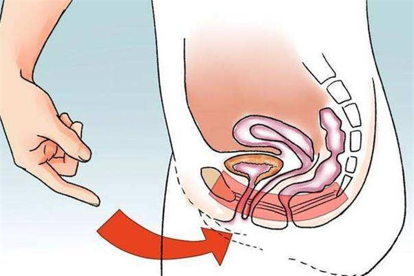 产后盆底肌修复是怎么做的,产后盆底肌松弛有什么方法修复
