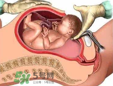 剖腹产最痛的阶段,剖腹产哪个环节最疼