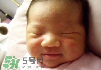 新生儿痤疮怎么治疗最好的方法,新生儿痤疮怎么治疗 新生儿痤疮怎么治疗最好的方法,新生儿痤疮怎么治疗