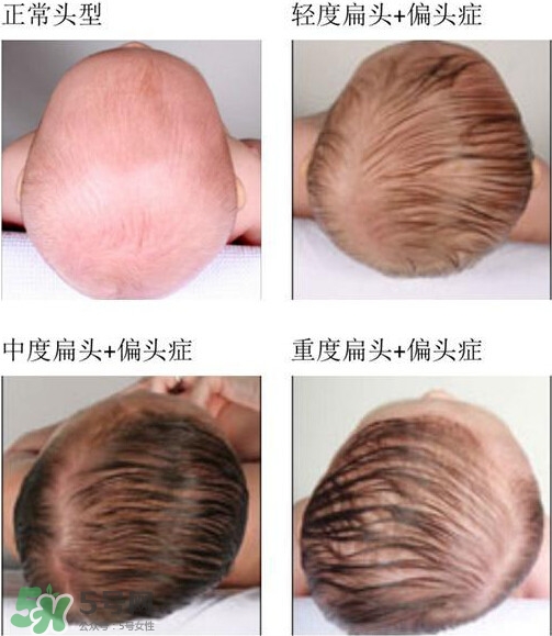 宝宝头型矫正最佳时间,宝宝几个月矫正头型