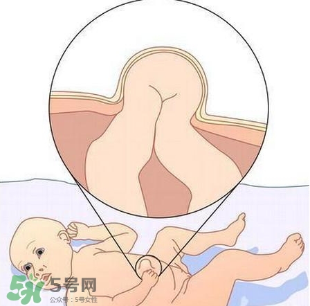 婴幼儿脐疝怎么治疗最有效,小孩脐疝怎么治疗