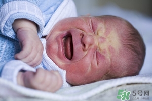 病理性黄疸症状及表现,病理性黄疸是什么原因引起的 病理性黄疸症状及表现,病理性黄疸是什么原因引起的