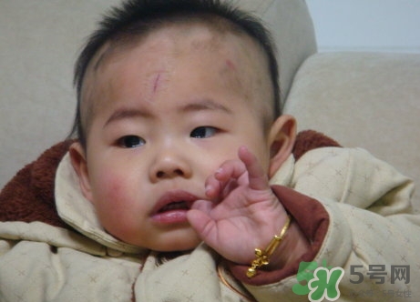 什么是青胎记,有青色胎记