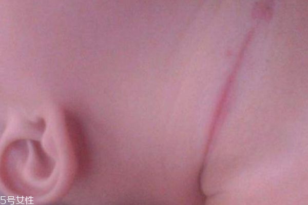 如何预防宝宝淹脖子,预防婴儿淹脖子最有效方法 如何预防宝宝淹脖子,预防婴儿淹脖子最有效方法