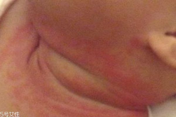 宝宝为什么会淹脖子,为什么会淹脖子