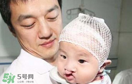 兔唇会遗传吗?,兔唇会遗传给下一代吗