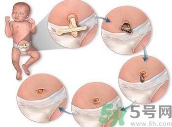 怎样可以让新生儿脐带尽快脱落,新生儿脐带脱落后怎么处理脐带 怎样可以让新生儿脐带尽快脱落,新生儿脐带脱落后怎么处理脐带