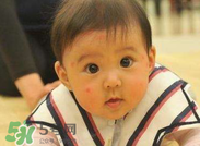 孩子被蚊子咬了怎么止痒,被小咬咬到奇痒难止怎么办