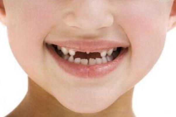 儿童大约几岁开始换牙,牙齿几岁开始换牙