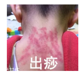 吮痧的注意事项,儿童吮痧后注意什么